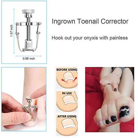 Image of Home Treatment for Ingrown Toenail -Surgery Grade Kit - AVM